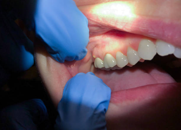 Best Emergency Tooth Extraction in St Stephen, SC
